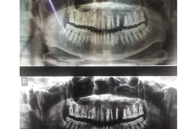 6-months-Post-surgery-X-ray-showing-Bone-Formation4