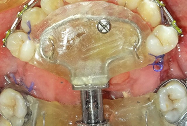 Anterior-Maxillary-Distraction-After-Completion-of-Distraction6