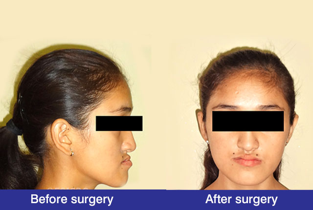 Anterior-Maxillary-Distraction-view-5