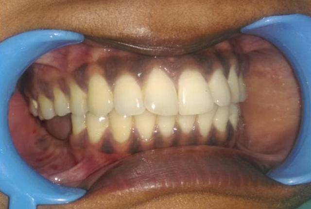 Dental-Implants-in-Edentulous-Area4