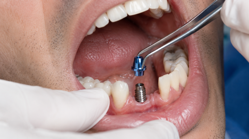 Dental Implants
