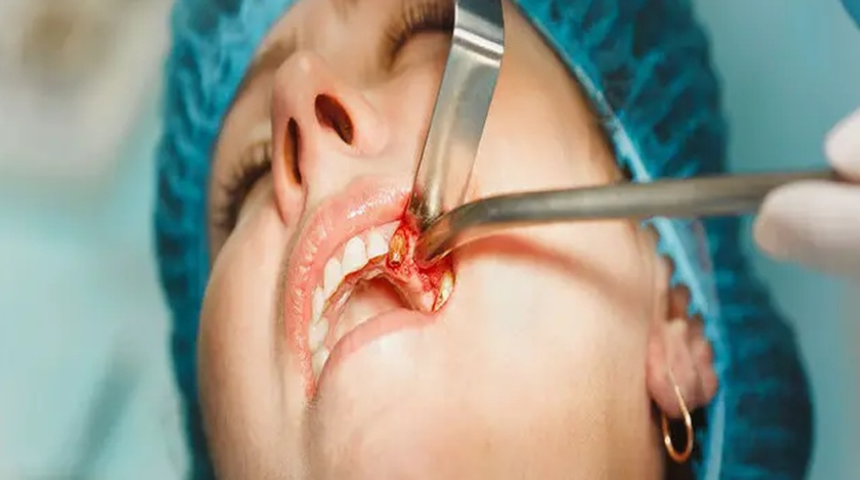 Dentoalveolar Surgery