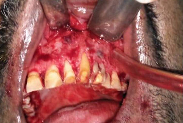 Intra-oral-Picture-of-Periapical-Lesion1