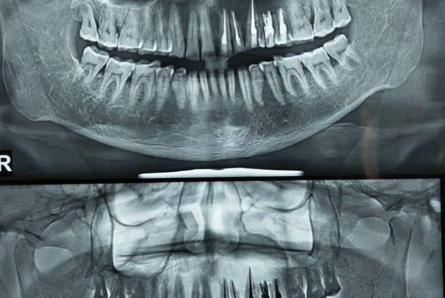OPG-Showing-Periapical-Lesion5