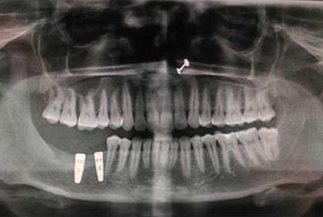 OPG-after-Implant-Placement6