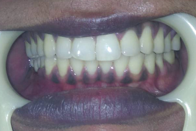 #Implant Supported Teeth In Alloplastic Bone Graft