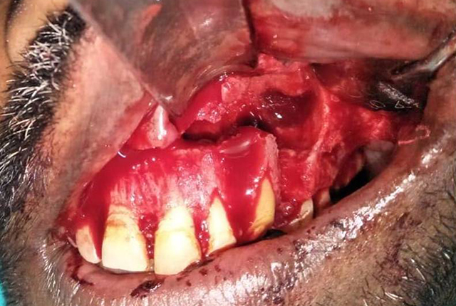 Photograph-after-removal-of-Periapical-Lesion2