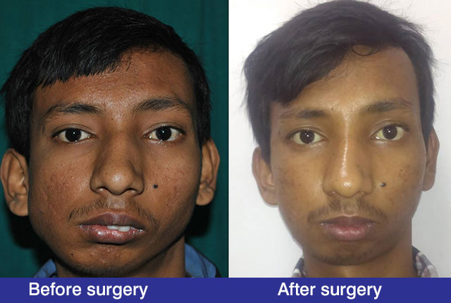TMJ-Ankylosis-After-Operation1