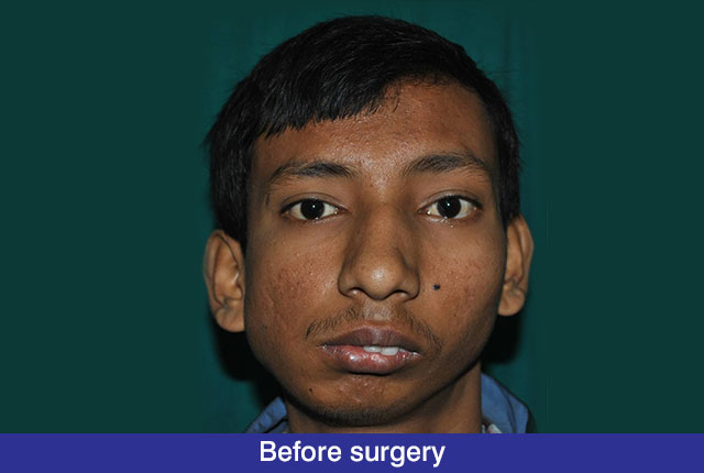 beforeTMJ-Ankylosis-Before-Operation2