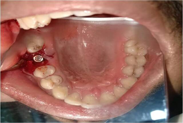dental-implant-1