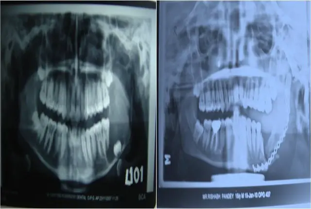 jaw-cyst-1