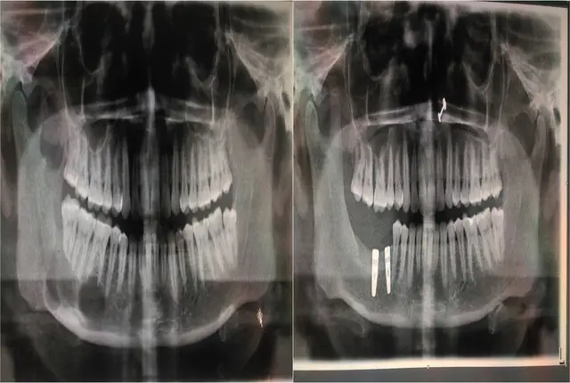 jaw-cyst-2