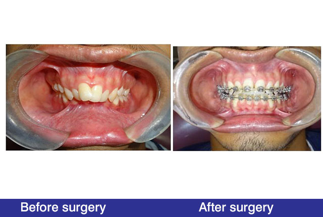 marge_Small-Lower-Jaw-Retrognathic-Mandible-Before-Operation-7