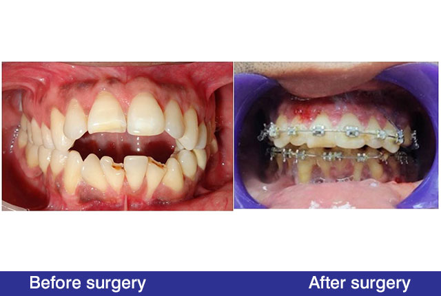 marge_Unable-to-Bite-From-Anterior-TeethOpen-Bite-After-Operation-1
