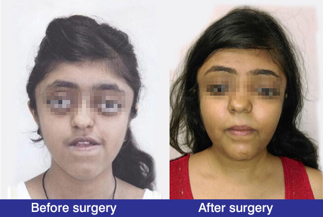 marge_distraction-osteogenesis-more-1