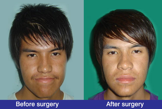 merge--surgery3